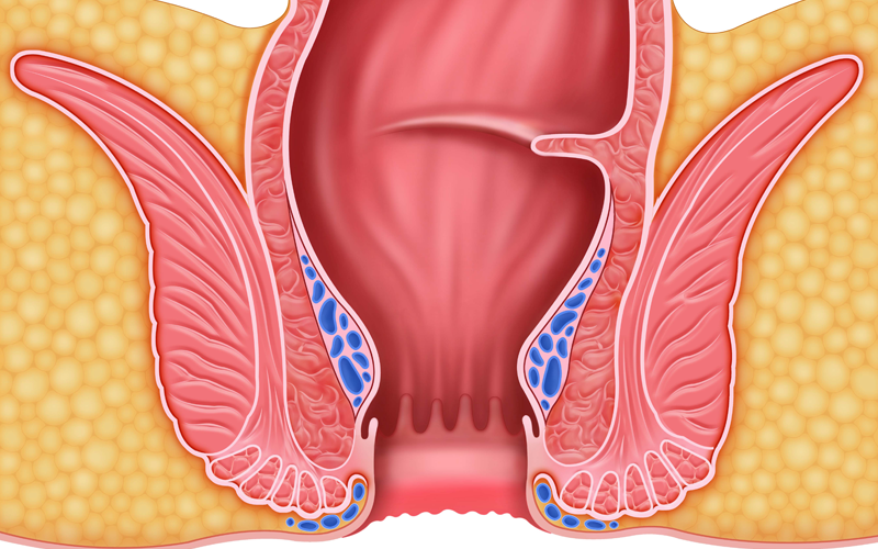 항문질환 클리닉
