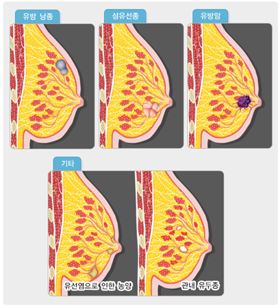 유방의 결절